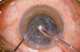 Phaco Surgeon